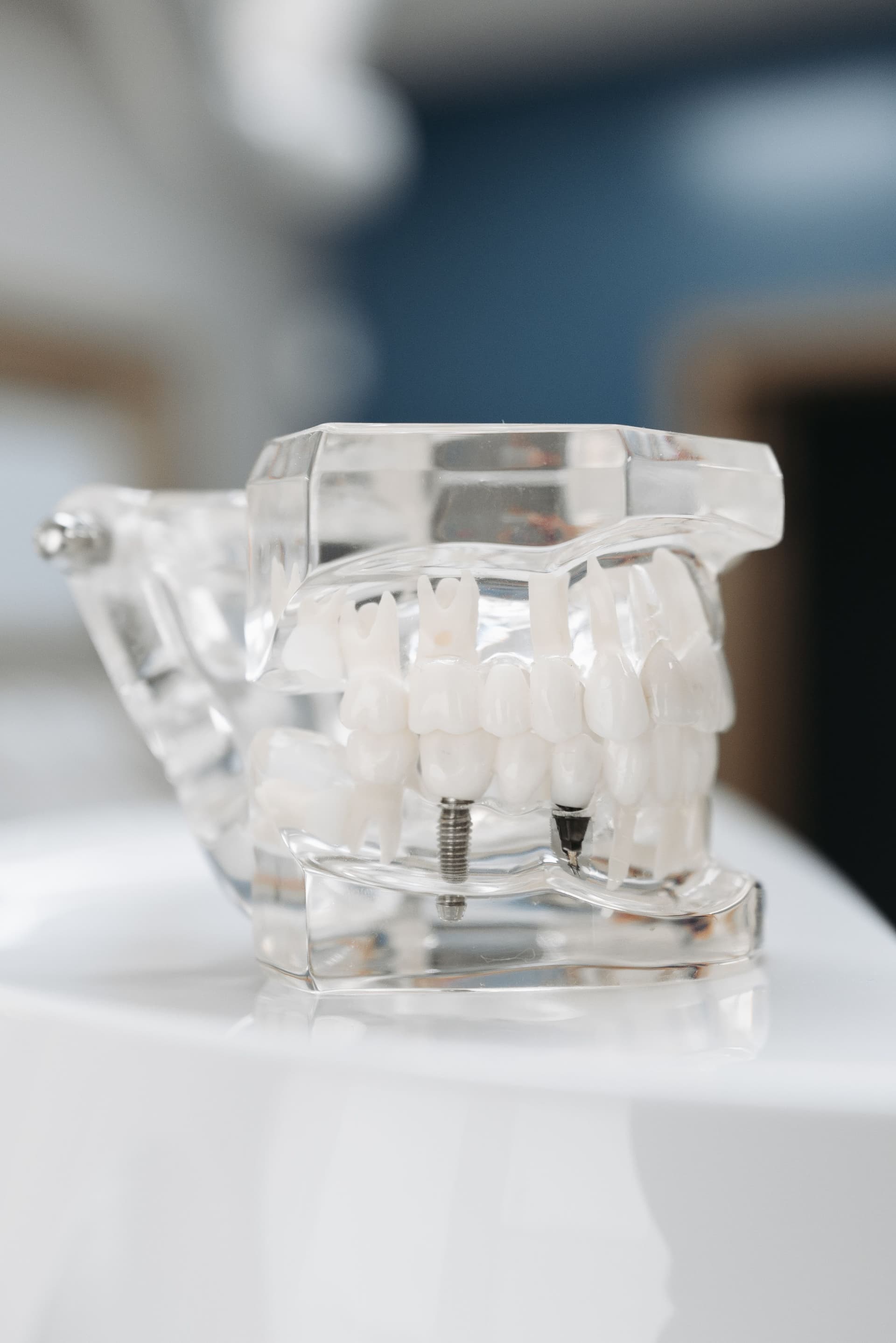 Implant Over-Dentures denture service