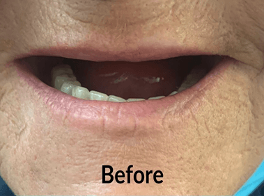 Before denture treatment smile transformation case four
